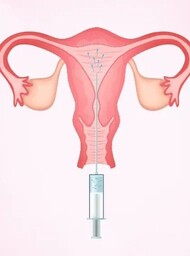 IUI Treatment